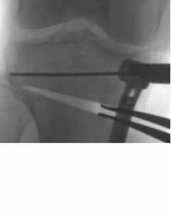 laminar spreaders opening up an osteotomy