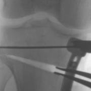 X-ray image to check the new gap.