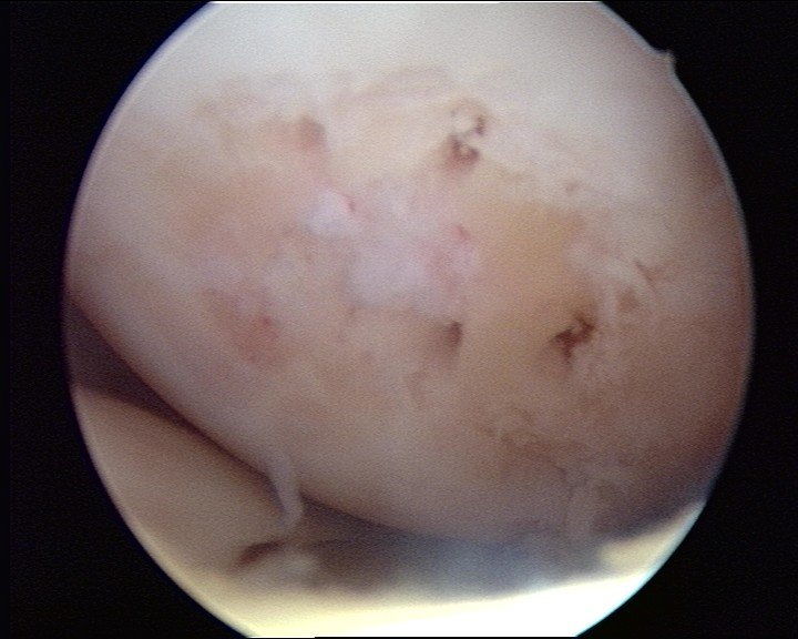 Photograph of the articular surface of the femur after a microfracture procedure, showing the small pick holes in the joint surface