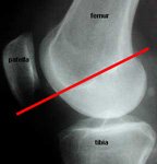 Lateral X-ray to show the position of Blumensaat's line.