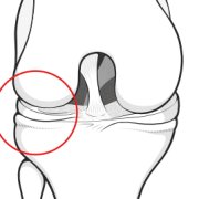 Illustration of the knee bones from the front, with a circle over the lateral compartment