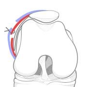 Illustration of suture of the cut superficial and deep layer of the lateral retinaculae