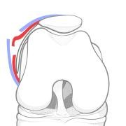 Illustration of release of the deep layer of the lateral retinaculum