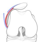Illustration showing cutting of the outer layer of the lateral retinaculum