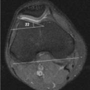 Scan image with the trochlear inclination angle in the normal range.