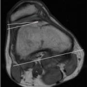Scan with measurements showing a reduced trochlear inclination angle.