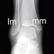 X-ray to show the ankle joint, with normal medial and lateral malleoi
