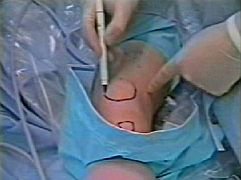 knee arthroscopy
