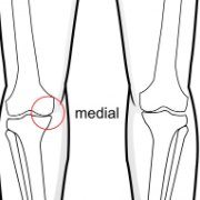 Sketch of the knee joints showing bone-on-bone contact where joint cartilage has been lost.