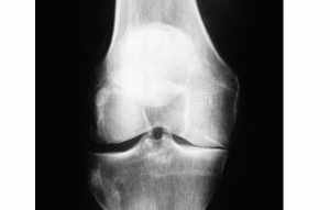 X-ray to show how one side of the knee joint has lost joint cartilage and is now 'bone-on-bone'.