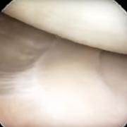 Photograph taken during arthroscopy to show how the meniscus attaches to the capsule at its outer edge.