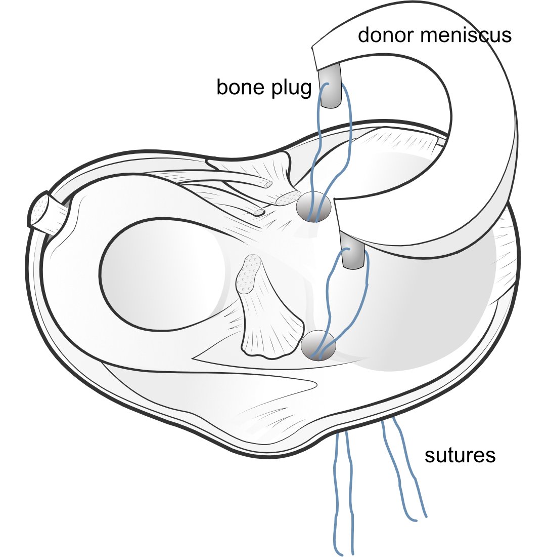 Illustration of the meniscus area at the top of the tibia, showing the prepared bone-plugs being slotted into the recipient area.