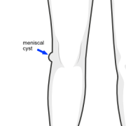 lateral meniscal cyst