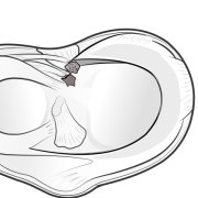 meniscal-root-avulsion.png