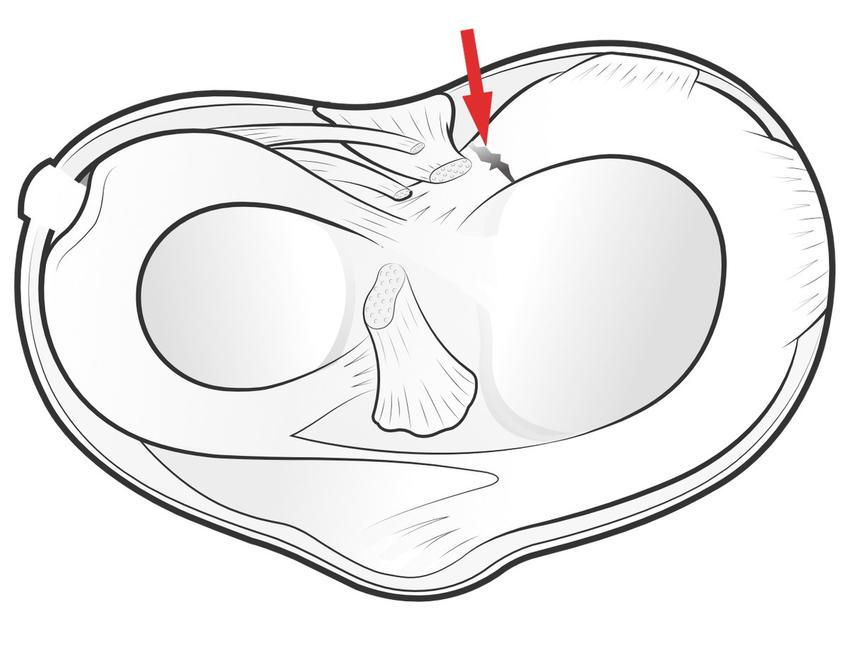 Illustration of the top of the tibia with the two menisci in place, and red arrow showing a tear at the meniscal root.