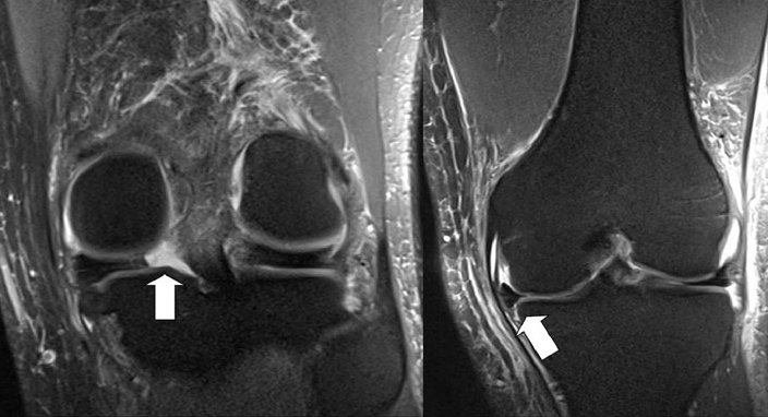 Two MRI slices. On the left the image reveals a 'gap sign' and on the right the image shows an avulsion of the meniscus.