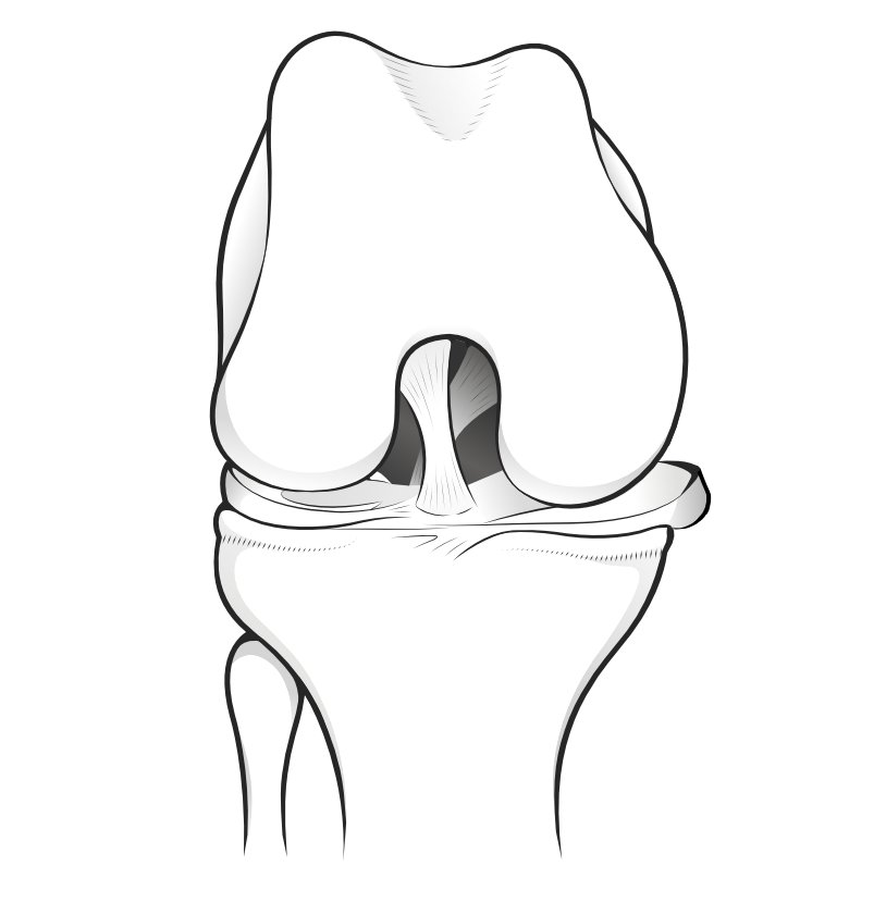 Illustration showing a meniscus avulsing over the edge of the tibial plateau.
