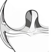 Illustration of a cutaway in the knee capsule to show how the menisci are attached to the capsule at the edges.