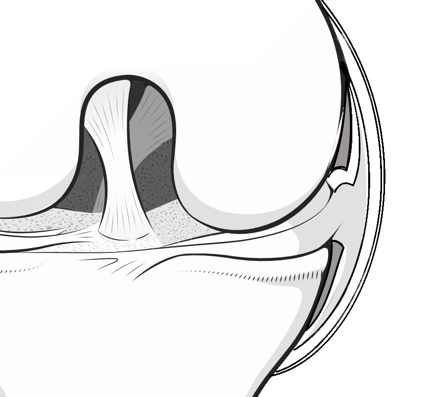 Illustration showing how the meniscus is attached around its outer edge to the capsule of the joint.