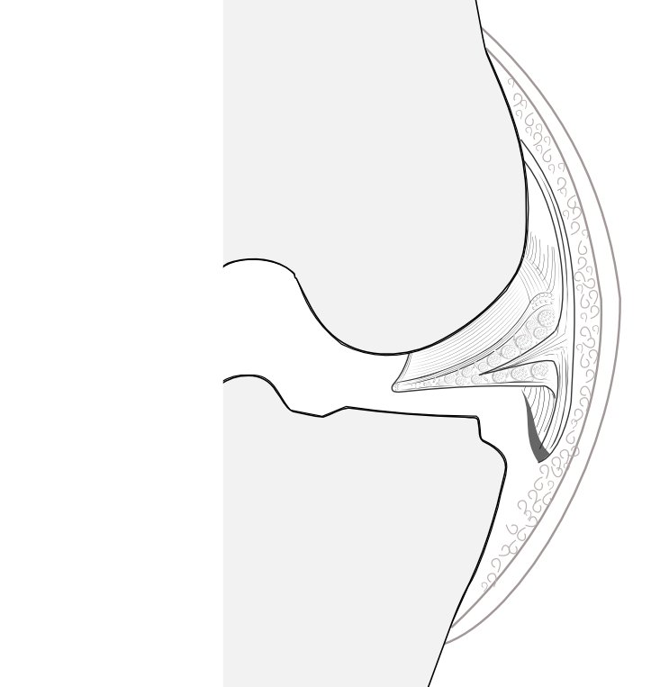 menisco-tibial avulsion