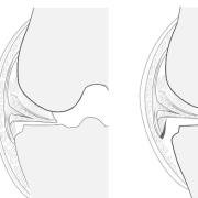 Two cropped illustrations demonstrating an intact and then a torn menisco-tibial ligament.