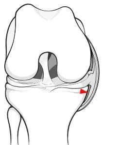 Illustration of the front of the knee, showing how the beak part of a parrot-beak meniscal tear can get stuck under the meniscus.
