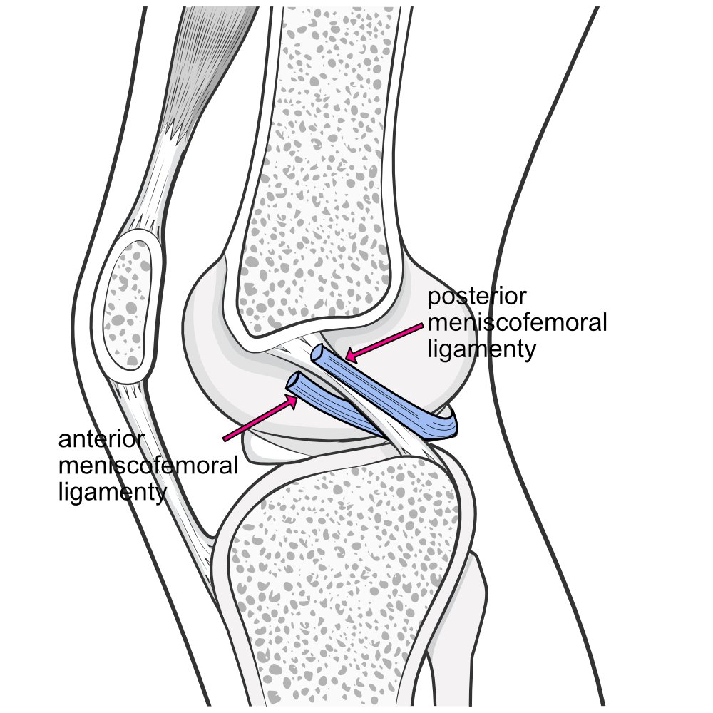 Illustration of knee joint cut to show how the two branches of the meniscofemoral ligament pass on either side of the posterior cruciate ligament.