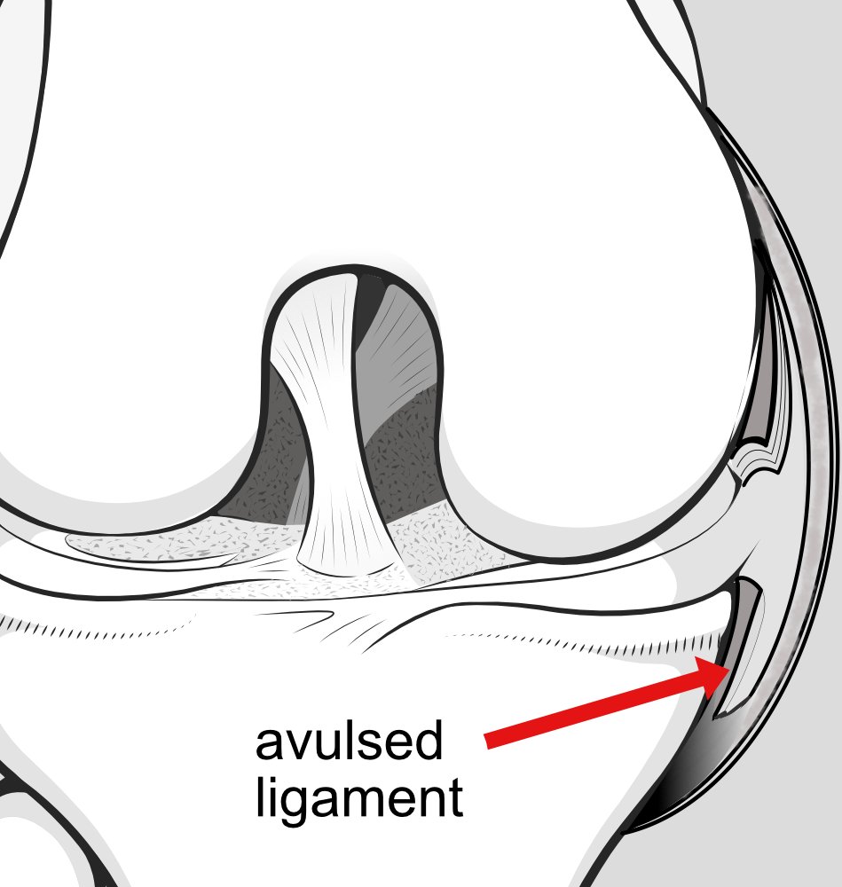 meniscotibial-ligament-avulsion