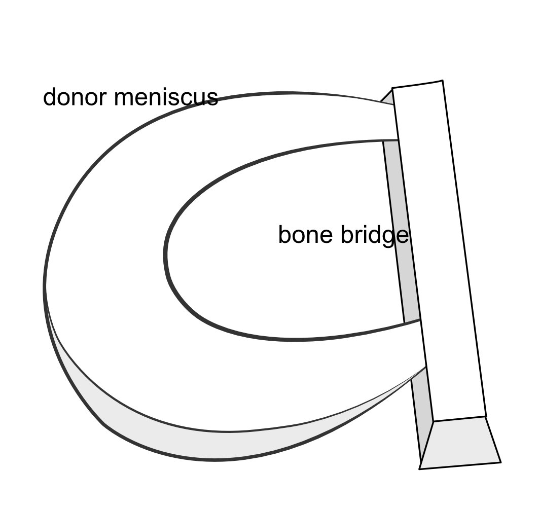 Illustration of a donor meniscus secured on a donor bone bridge.