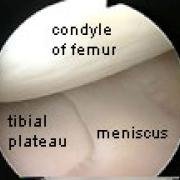 knee meniscus