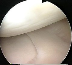 meniscus01b.jpg