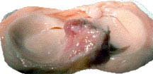 Donor meniscus being prepared for transplant