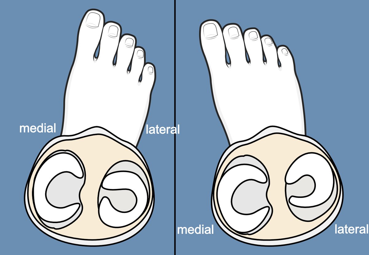 Illustration showing how the medial meniscus moves more than the lateral when the leg is twisted.