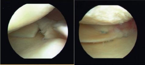 Two photographs taken during separate arthroscopic procedures. On the left a meniscal root tar is evident. On the right, on a follow-up surgery, healing is taking place in the repaired meniscus.