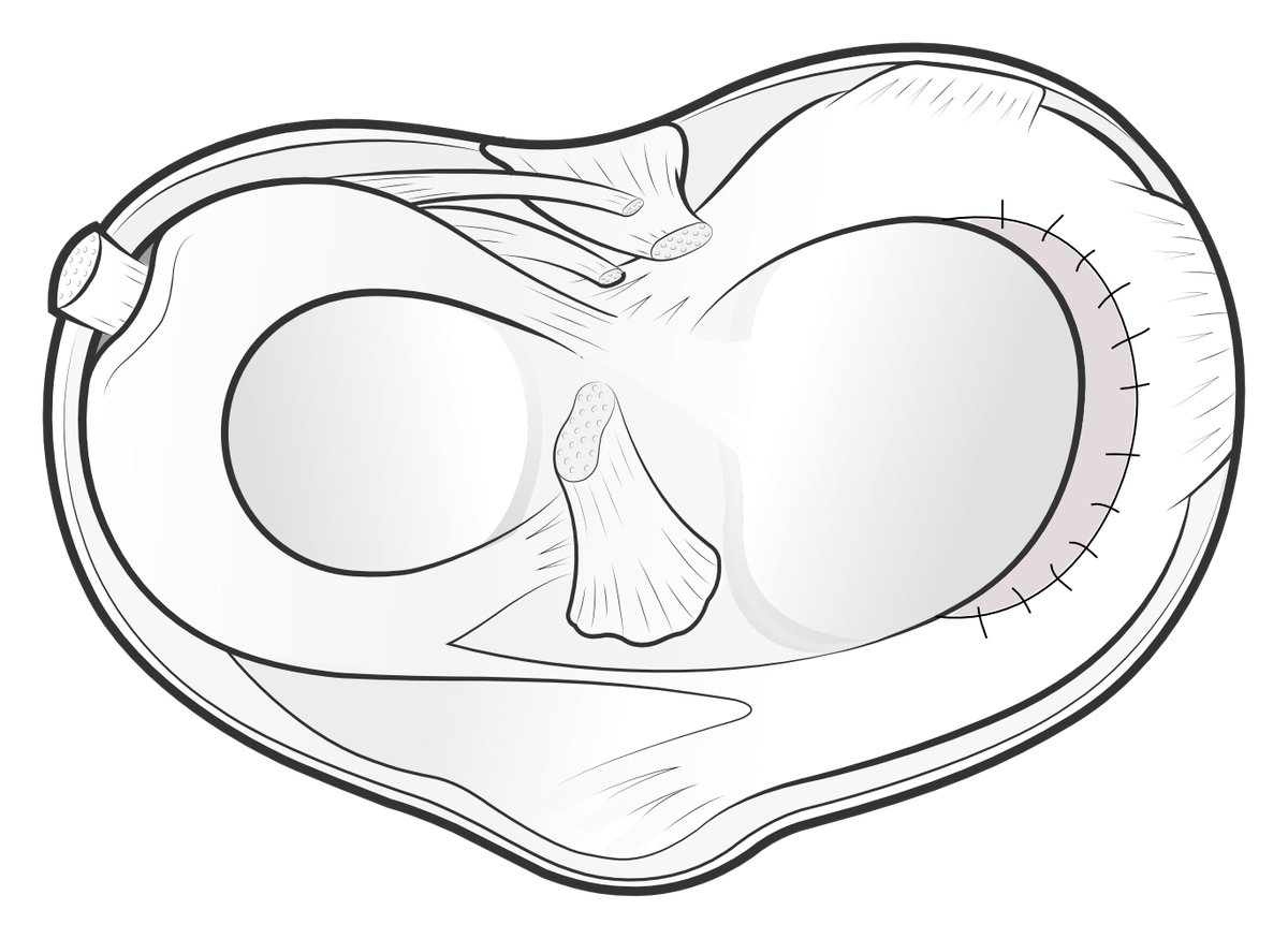 Illustration to show a meniscus scaffold, trimmed and sewn into a defect on the meniscus..
