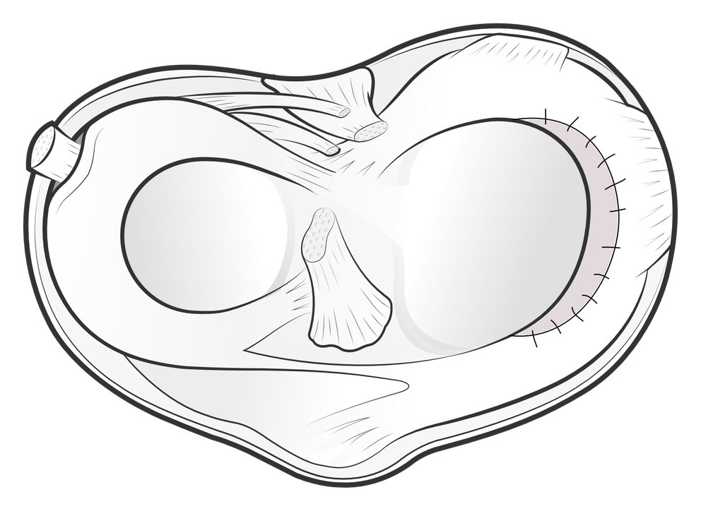 Illustration of the menisci on the top of the tibia, to show an area of a meniscal scaffold that has been sewn into place.