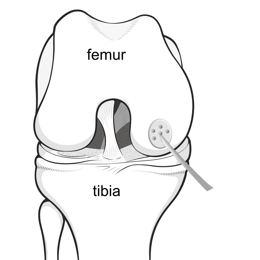 Illustration of the front of the knee, with microfracture being performed by a pick.