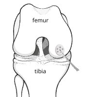 Illustration of the joint surface of the femure, showing microfracture being performed with a small pick.
