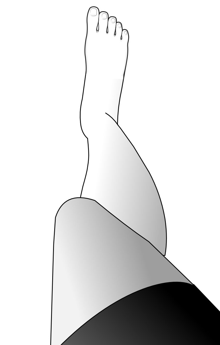Illustration of the lower limb from above showing the patella squinting inwards, despite the foot pointing forwards.