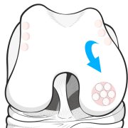 Illustration of the front of the knee, showing the cartilage plugs of a recent mosaicplasty.