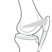 medial patellofemoral ligament or MPFL