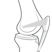 Illustration of the medial patellofemoral ligament on the inner aspect of the knee, attached to both tibia and patella.