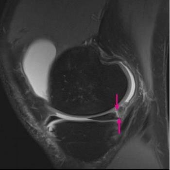 MRI image of a lateral MRI slice through the knee, with red arrows pointing to a ramp lesion at the back of the meniscus.