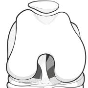 kneecap well located in trochlear groove