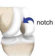 Illustration of the bones at the front of the knee, showing the notch between the two rounded condyles of the femur.