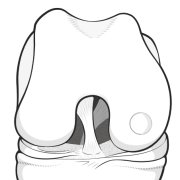 Illustration of a prepared osteochondral defect plugged with new cartilage.