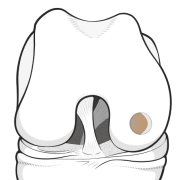 Illustration of front of femoral condyle showing a defect prepared for an osteochondral plug.