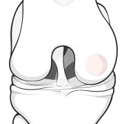 Illustration of the front of the knee after an OATS procedure.