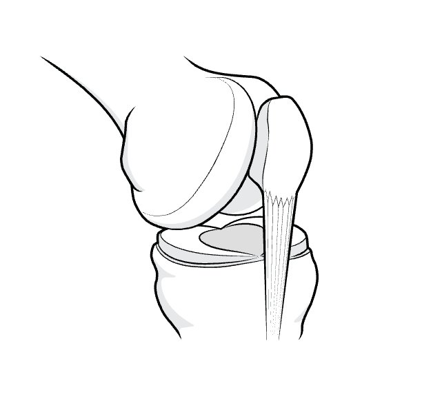 Illustration of the patella and patellar tendon from an oblique viewpoint