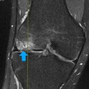 MRI scan of the front of the knee to show a crater in the cartilage.